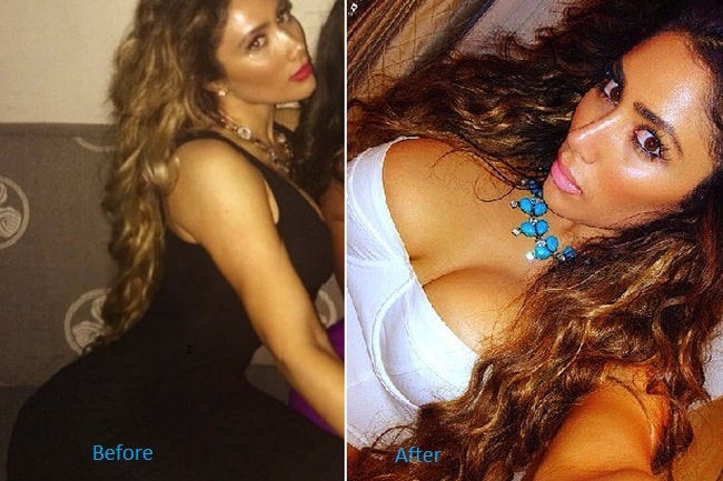 Nikki Baby before and after breast augmentation.